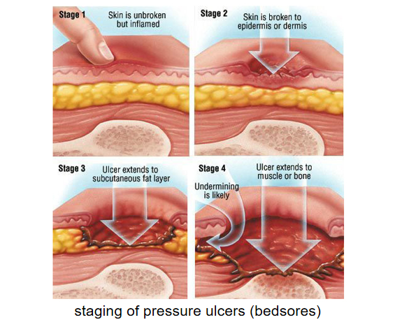 انطلاق قرح الضغط (تقرحات الفراش) 6.10.png