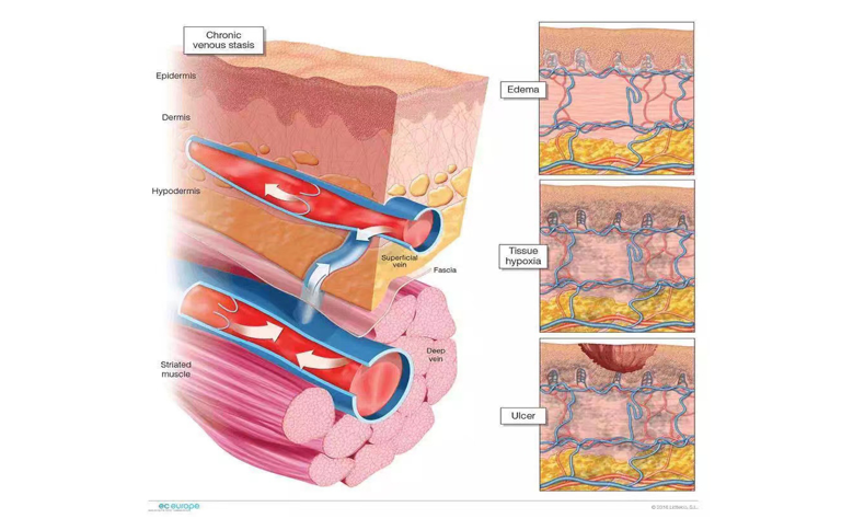 الساق venou sulcer