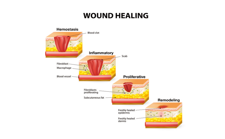 wound healing