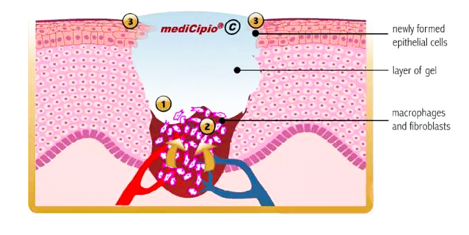 Alginate dressings